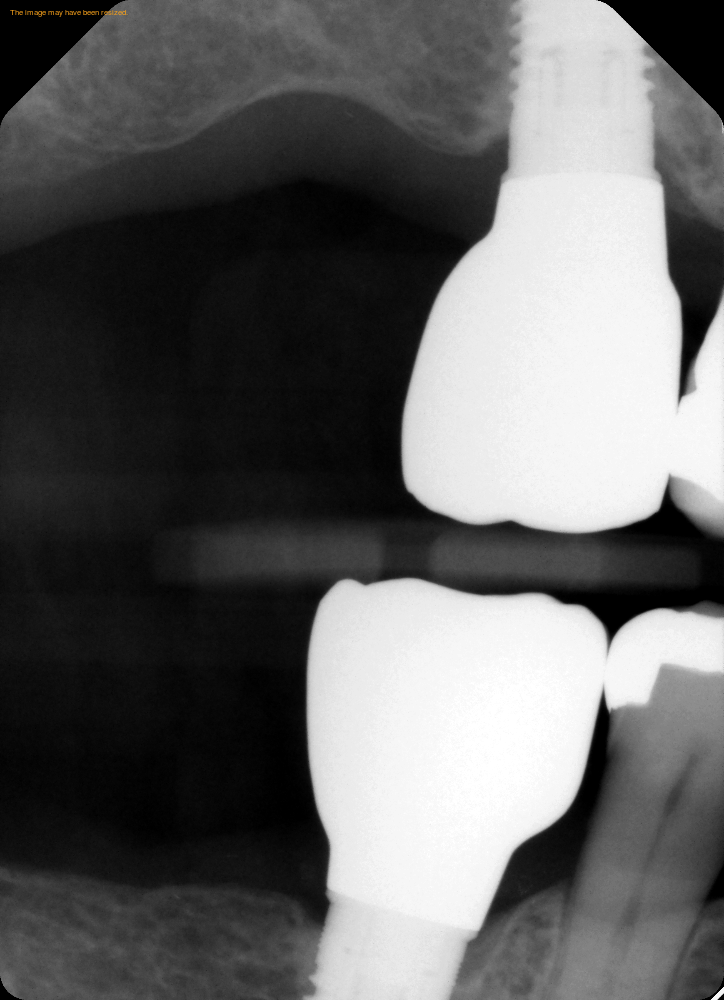 Dental Implants 