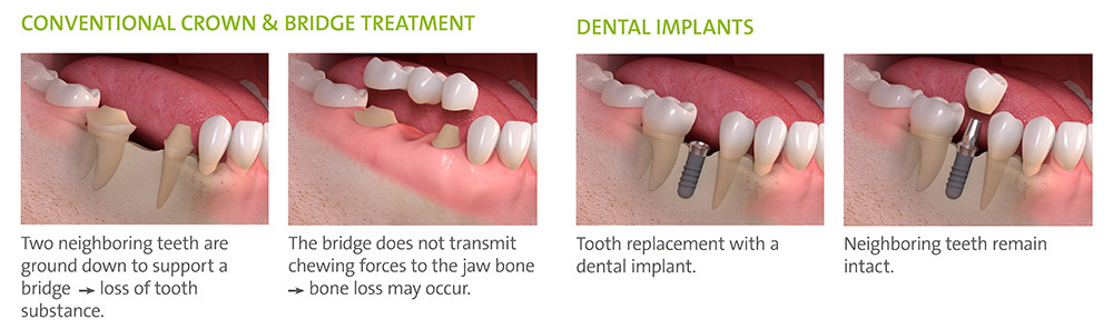 Dental Implants in Cedar Park | Reveal Dental