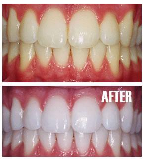 Teeth Whitening In Cedar park | Reveal Dental