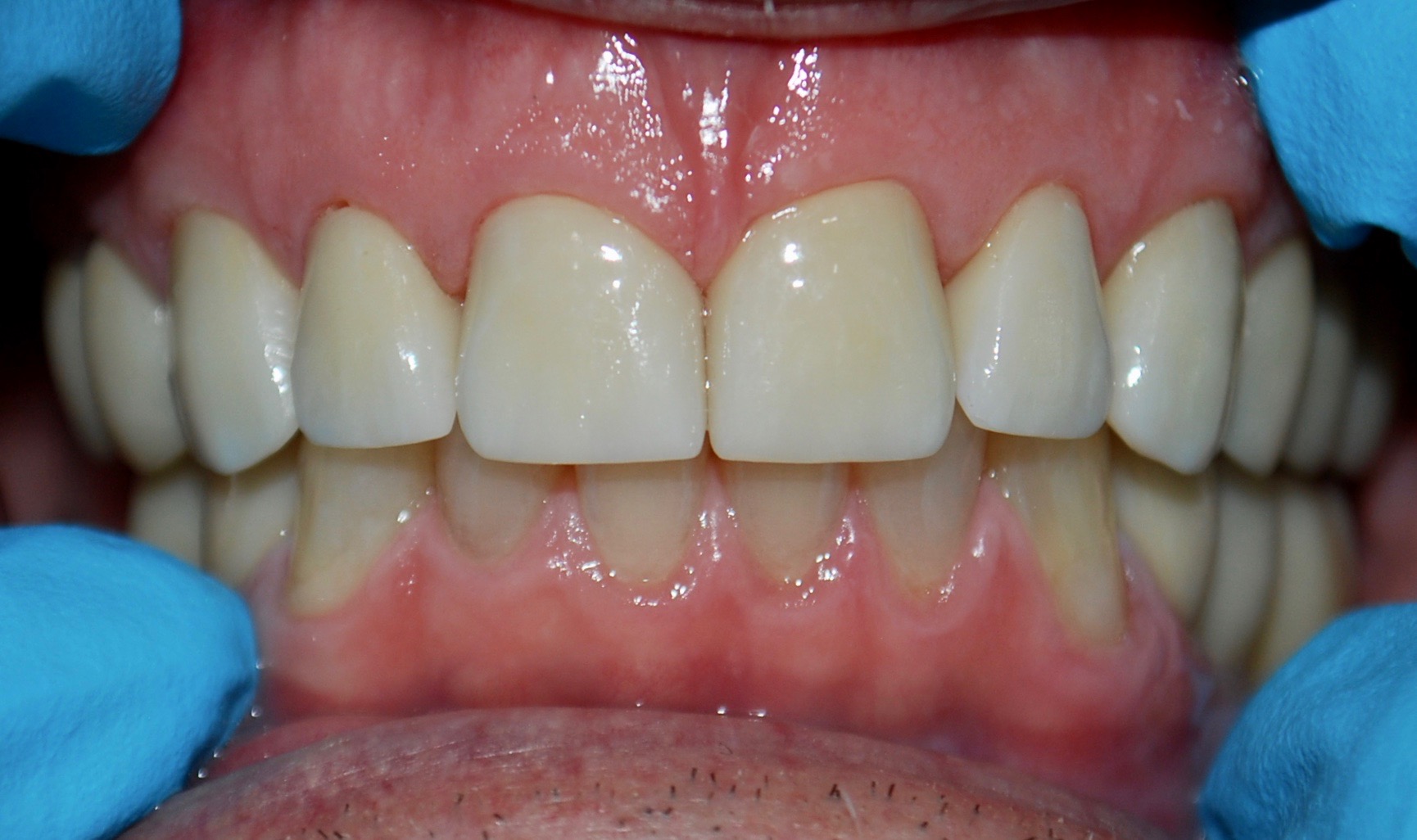 Dental Implants | Revdeal Dental