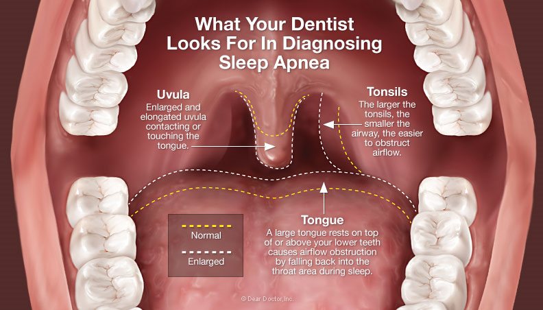 Oral Appliance for Sleep Apnea | Reveal Dental