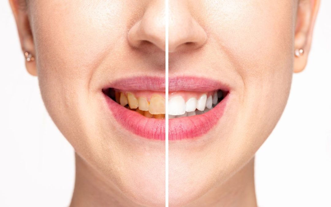 Teeth Cleaning in Cedar Park | Reveal Dental