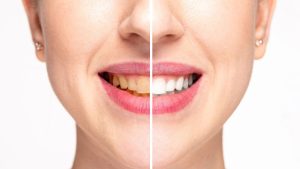 Teeth Cleaning in Cedar Park | Reveal Dental
