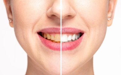 The Benefits of Regular Professional Teeth Cleaning in Cedar Park