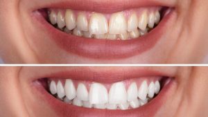 Teeth Whitening | Reveal Dental