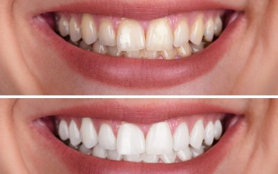 How To Improve The Results Of Your Cedar Park Teeth Whitening