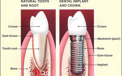 What Happens After You Get Dental Implants?