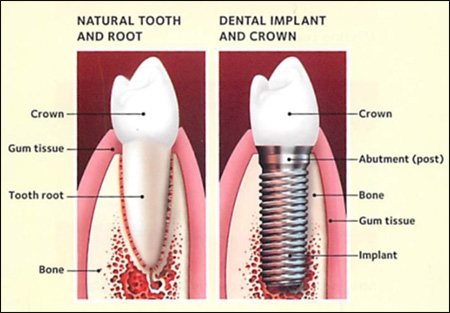 Full Dental Implant Specifications