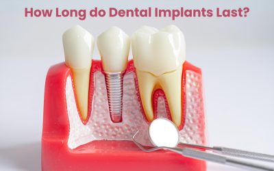 Dental Implant Longevity: How Long do Dental Implants Last