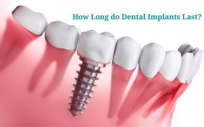 Why Dental Implants in Cedar Park Are the Best Choice for Replacing Teeth