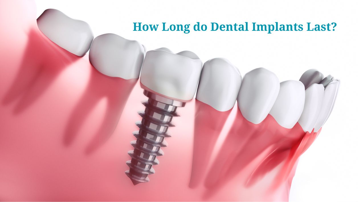 Benefits of Choosing Dental Implants in Cedar Park