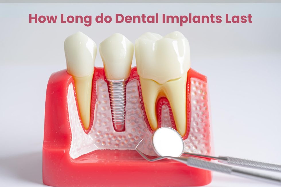 Understanding Dental Implants in Cedar Park Reveal Dental
