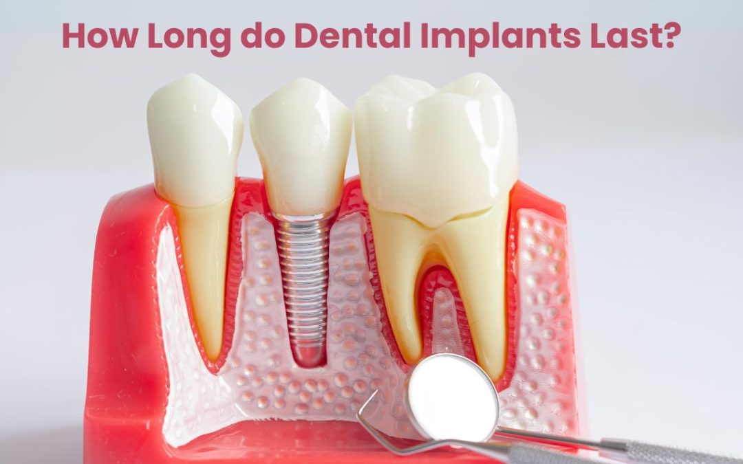 Dental Implants in Cedar Park - Reveal Dental