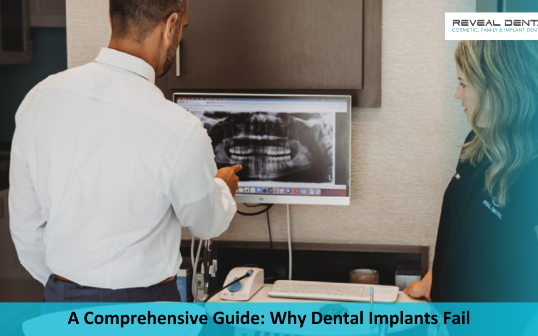 A Comprehensive Guide: Why Dental Implants Fail