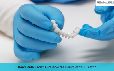 How Dental Crowns Preserve the Health of Your Teeth?