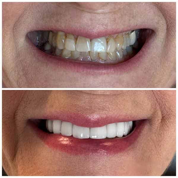 Before and After image of Porcelain Veneers and Crowns