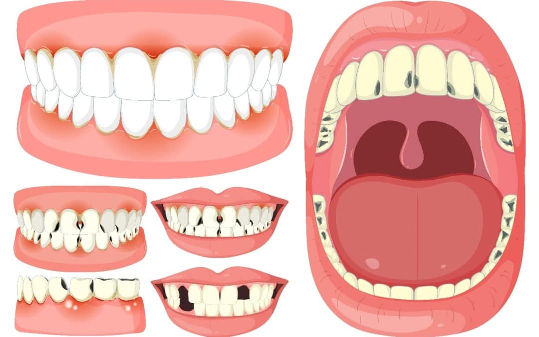 Can Veneers Fix Crooked Teeth?