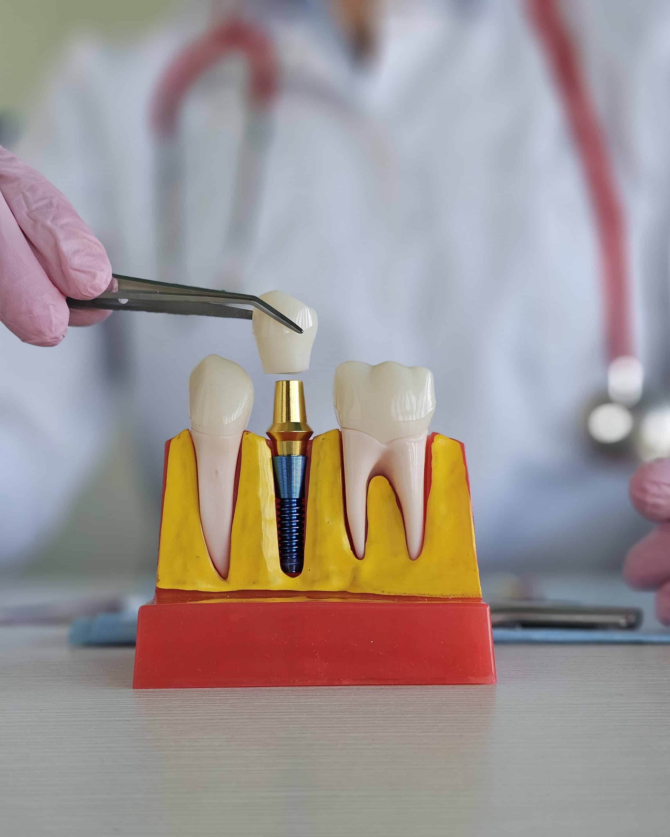 Dental implants in Cedar Park | Reveal Dental