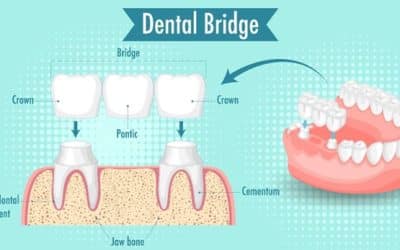 Dental Bridges vs Implants – Find Out Which is Better for You