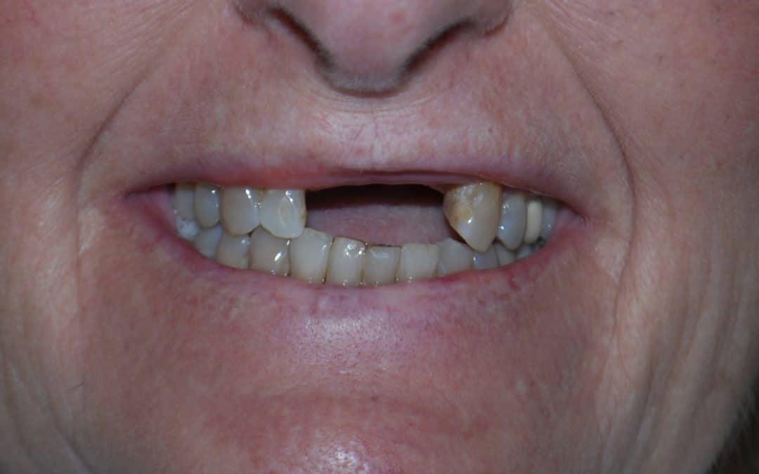 Understanding the Different Types of Dental Implants for Tooth Replacement