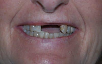 Understanding the Different Types of Dental Implants for Tooth Replacement